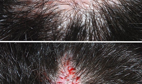 Hair-transplantation-Hair-Loss-Strong-Hair-Formula