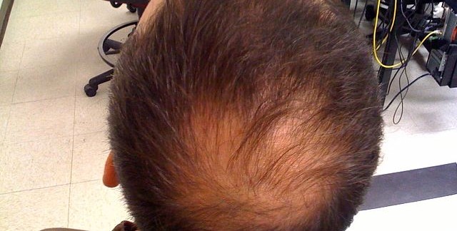 Hair loss, also known as alopecia or baldness, refers to a loss of hair from the head or body. Baldness can refer to general hair loss or male pattern hair loss. Hair loss and hypotrichosis have many causes including androgenetic alopecia, fungal infection, trauma (e.g., due to (trichotillomania), radiotherapy, chemotherapy, nutritional deficiencies (e.g., iron deficiency), and autoimmune diseases (e.g.,alopecia areata). Hair loss severity occurs across a spectrum with extreme examples including alopecia totalis (total loss of hair on the head) and alopecia universalis (total loss of all hair on the head and body).